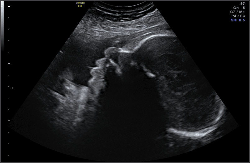 35 гестационна седмица – 35 седмица от бременността